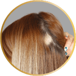 Terapia Capilar Alopecia Frontal Fibrosante