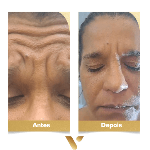 Estética facial, botox, limpeza de pele, cidade nova belo horizonte