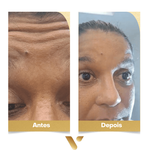 Estética facial, botox, limpeza de pele, cidade nova belo horizonte