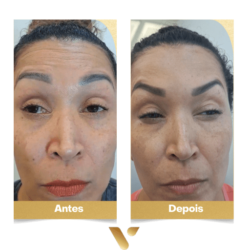 Estética facial, botox, limpeza de pele, cidade nova belo horizonte