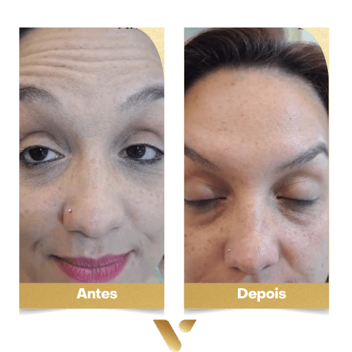 Estética facial, botox, limpeza de pele, cidade nova belo horizonte