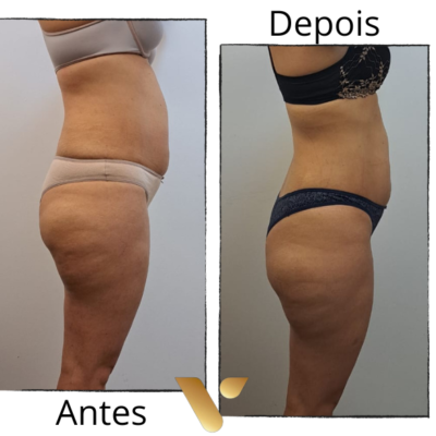 SlimDetox cidade nova reducao de medidas abdominais