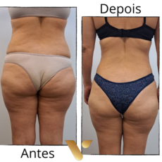 SlimDetox cidade nova reducao de medidas abdominais