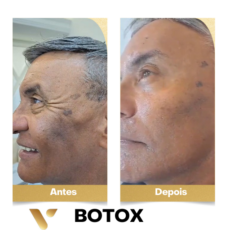 Resultados botox Cidade Nova BH, Resultados Botox Belo Horizonte, Botox cidade nova, botox perto de mim, botox, botox belo horizonte, botox facial, estética facial, estética cidade nova, estética belo horizonte