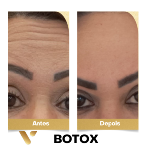 Resultados botox Cidade Nova BH, Resultados Botox Belo Horizonte, Botox cidade nova, botox perto de mim, botox, botox belo horizonte, botox facial, estética facial, estética cidade nova, estética belo horizonte