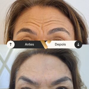 Botox - Redução de Linhas de Expressão