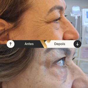 Botox - Redução de Linhas de Expressão