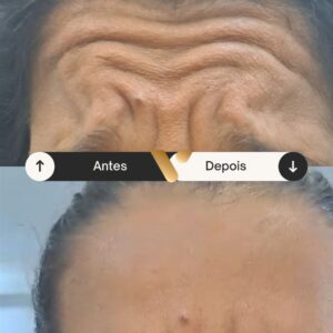 Botox - Redução de Linhas de Expressão