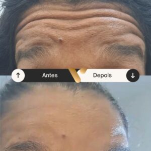 Botox - Redução de Linhas de Expressão