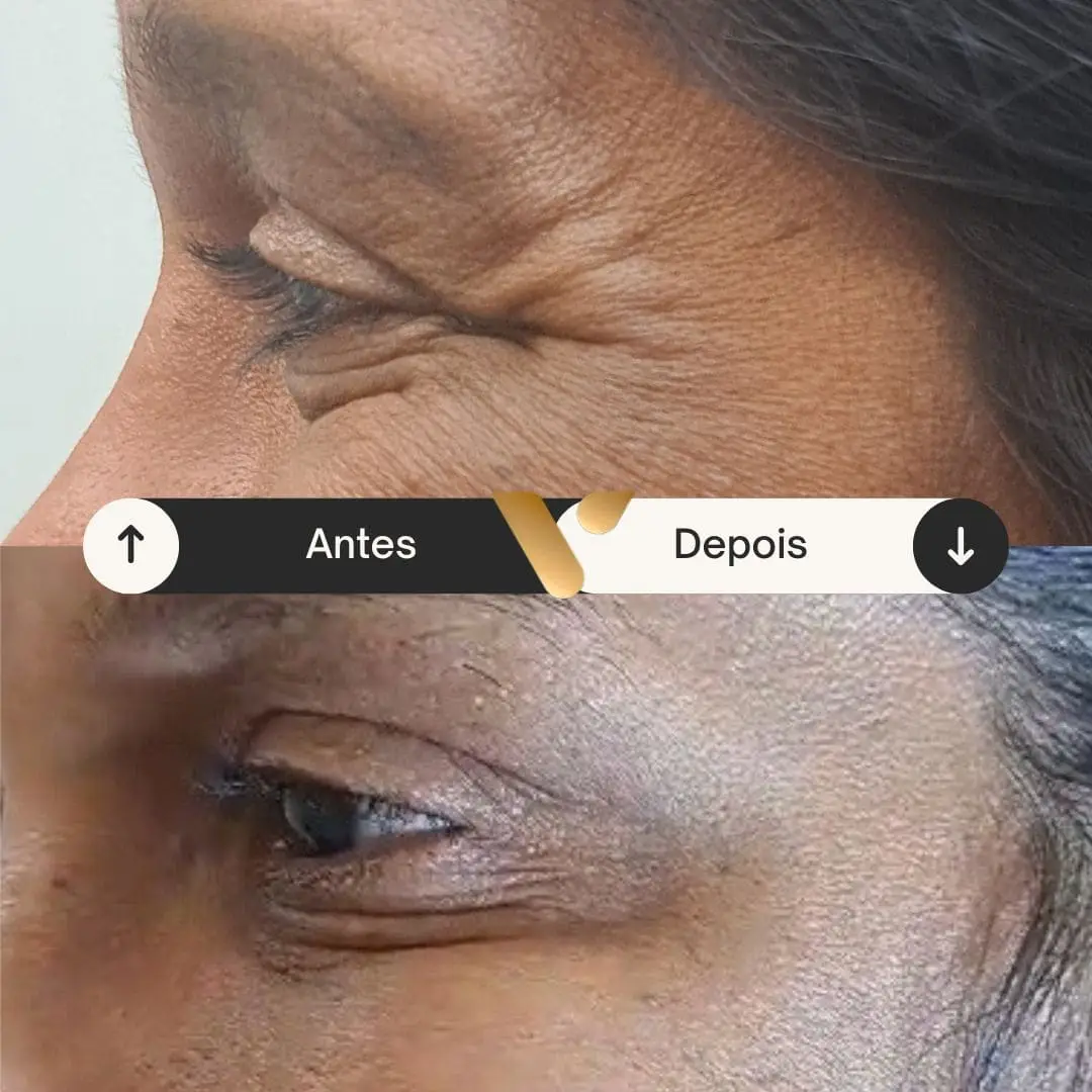 BOTOX-CIDADE NOVA- BELO HORIZONTE