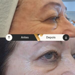 Botox - Redução de Linhas de Expressão