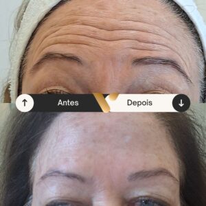 Botox - Redução de Linhas de Expressão