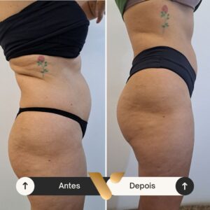 Resultados corporais via beauty estetica, cidade nova bh