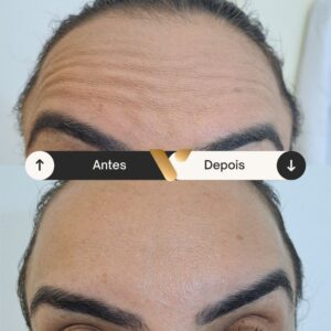 Botox - Redução de Linhas de Expressão