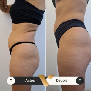 Resultados corporais via beauty estetica, cidade nova bh