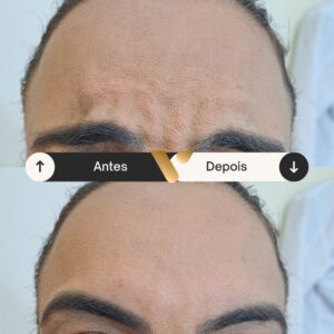 Botox - Redução de Linhas de Expressão