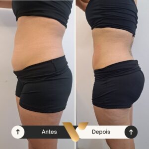 Resultados corporais via beauty estetica, cidade nova bh