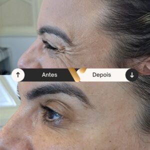 Botox - Redução de Linhas de Expressão