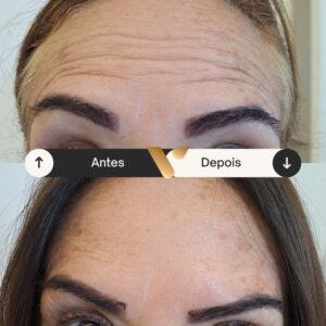 Botox - Redução de Linhas de Expressão