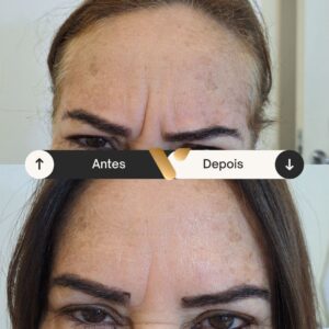 Botox - Redução de Linhas de Expressão