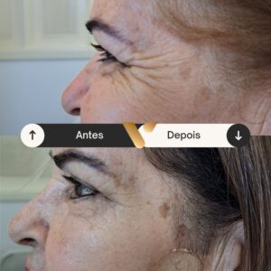 Botox - Redução de Linhas de Expressão