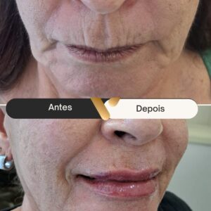 BOTOX-CIDADE NOVA- BELO HORIZONTE