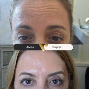 BOTOX-CIDADE NOVA- BELO HORIZONTE