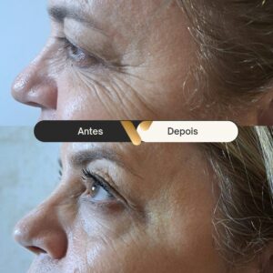 BOTOX-CIDADE NOVA- BELO HORIZONTE