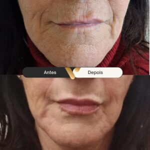 BOTOX-CIDADE NOVA- BELO HORIZONTE