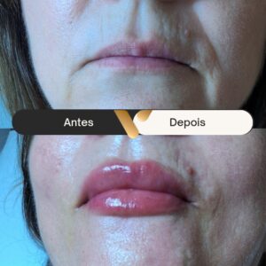 BOTOX-CIDADE NOVA- BELO HORIZONTE