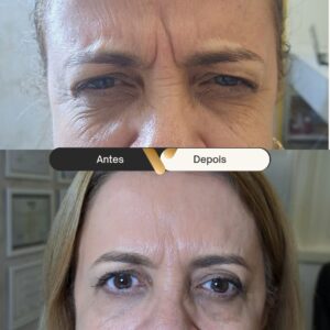 BOTOX-CIDADE NOVA- BELO HORIZONTE