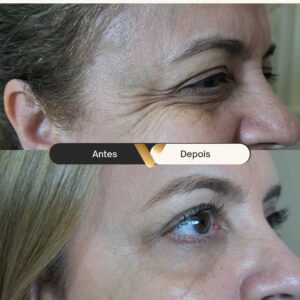 BOTOX-CIDADE NOVA- BELO HORIZONTE