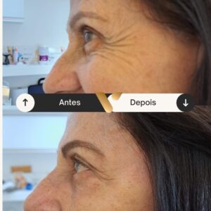 BOTOX-CIDADE NOVA- BELO HORIZONTE