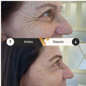 BOTOX-CIDADE NOVA- BELO HORIZONTE