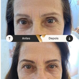 BOTOX-CIDADE NOVA- BELO HORIZONTE